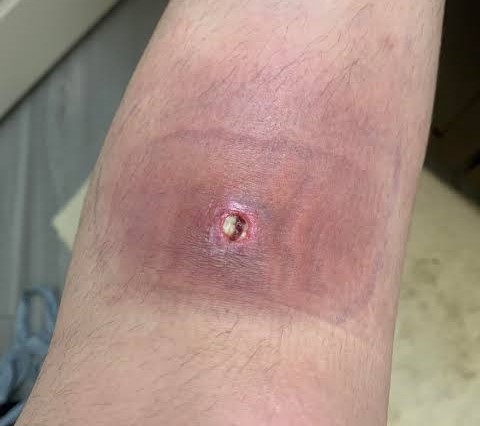 CICATRIZACIÓN DE HERIDAS